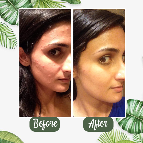 LIMETOW®Hot Sale Green Ted Deep cleanse Mask
