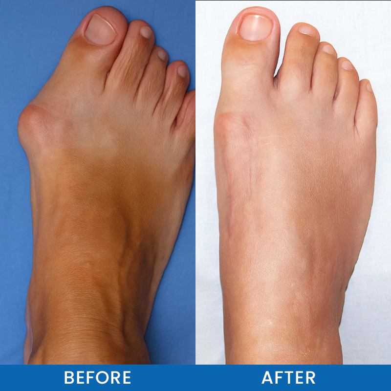 LIMETOW® Bunion-Free Solution