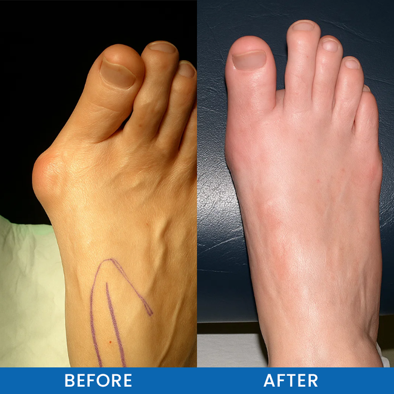 LIMETOW® Bunion-Free Solution