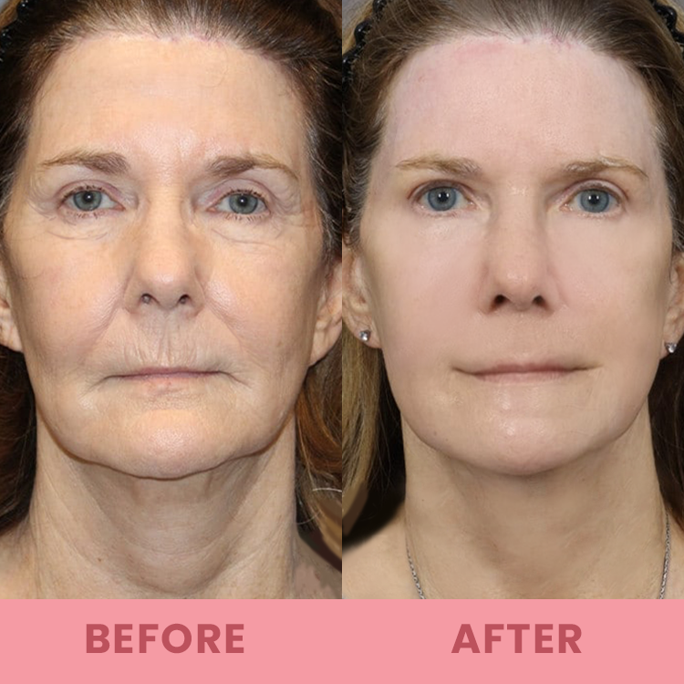 đĽLimited Time Offerâ°LIMETOW⢠Compact Anti-wrinkle Bar
