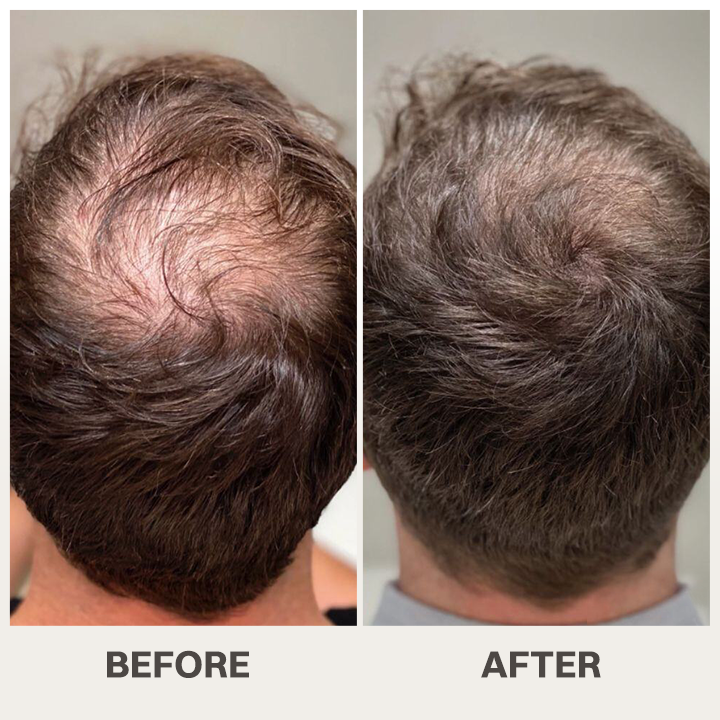 LIMETOW® Scalpy Hair Serum — The Scalp-First Hair Growth Breakthrough