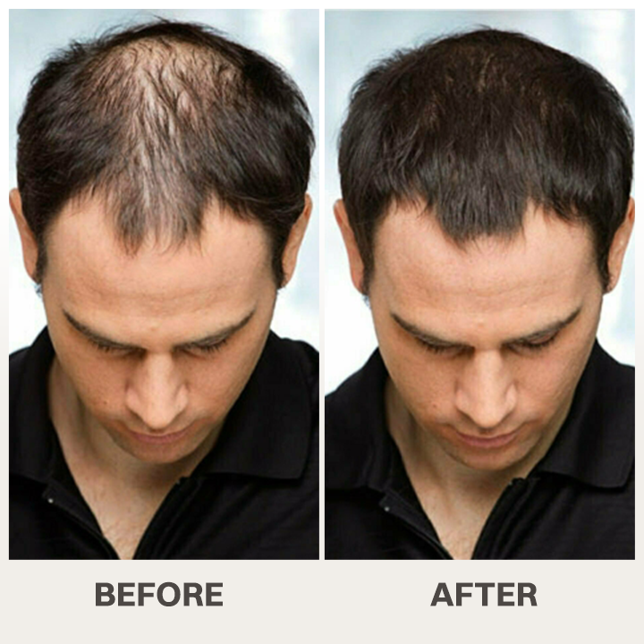 LIMETOW® Scalpy Hair Serum — The Scalp-First Hair Growth Breakthrough