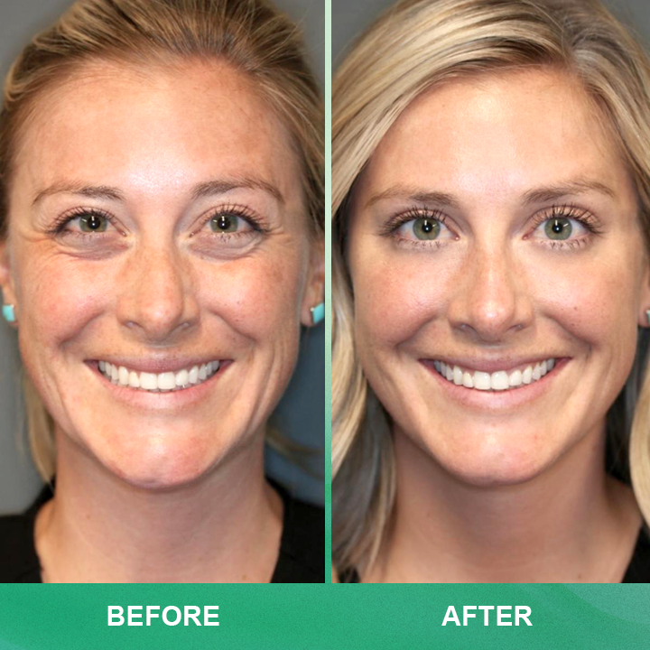 ⏰Limited Time Offer⏰LIMETOW™ Anti-wrinkle Cream Stick