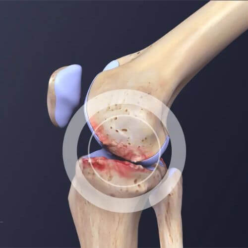 LIMETOW®Natural Knee Pain Patches image LIMETOW®Natural Knee Pain Patches