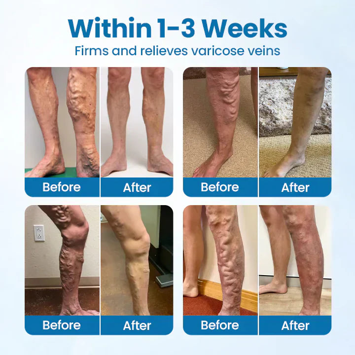 🇨🇦👨‍⚕️✅✅LIMETOW® VeinTarget Microneedle Patch