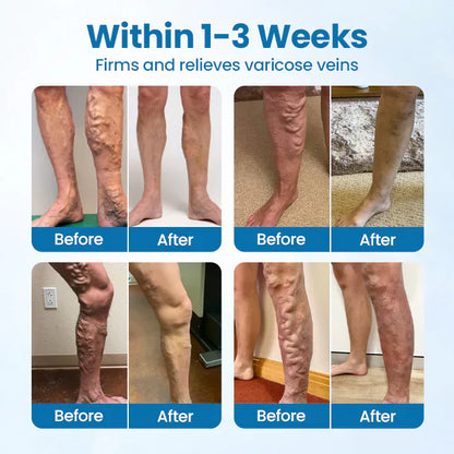 🇨🇦👨‍⚕️✅✅LIMETOW® VeinTarget Microneedle Patch