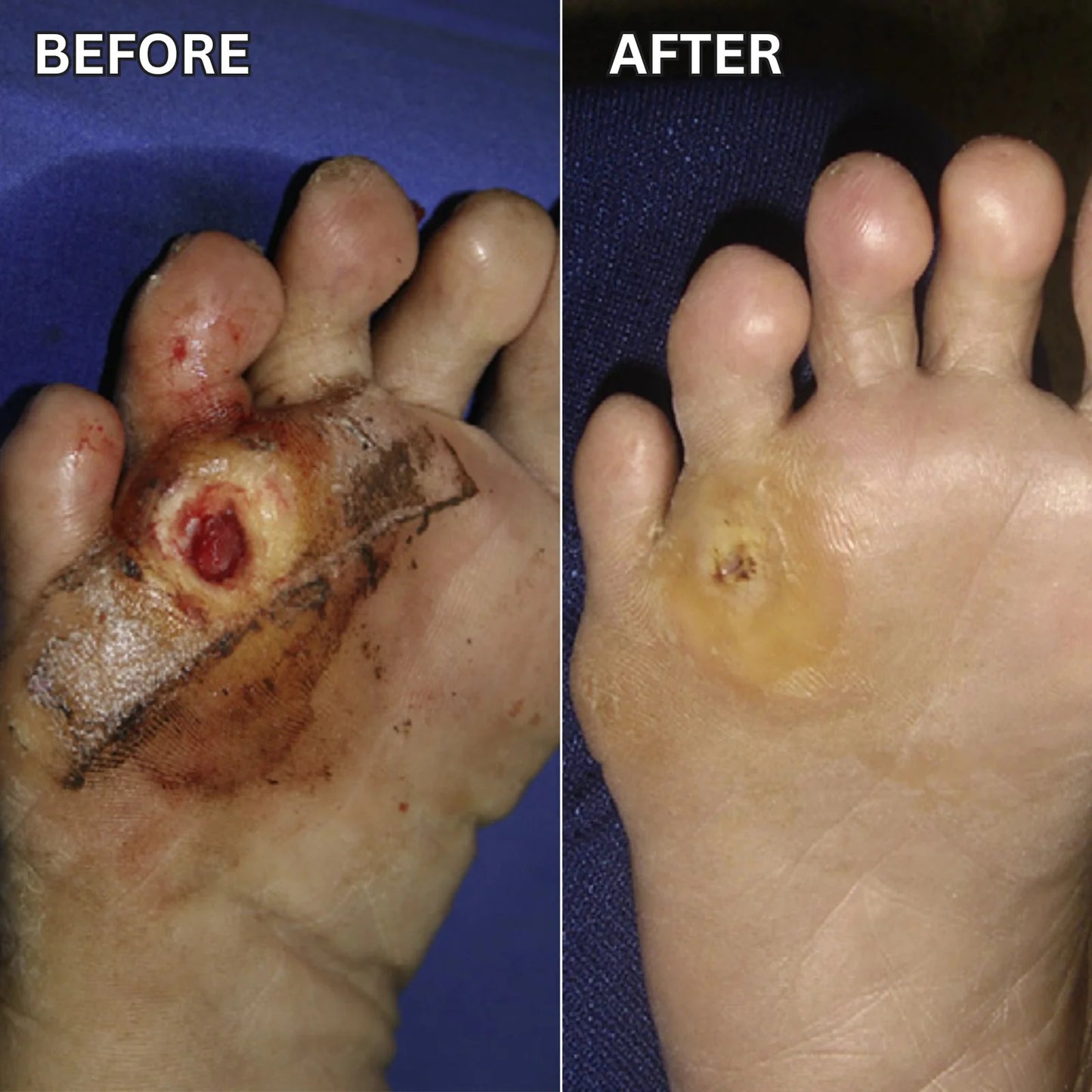 Shield Fragile Diabetic Feet in as Littleas 60 Seconds