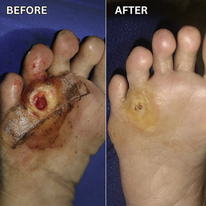 Shield Fragile Diabetic Feet in as Littleas 60 Seconds