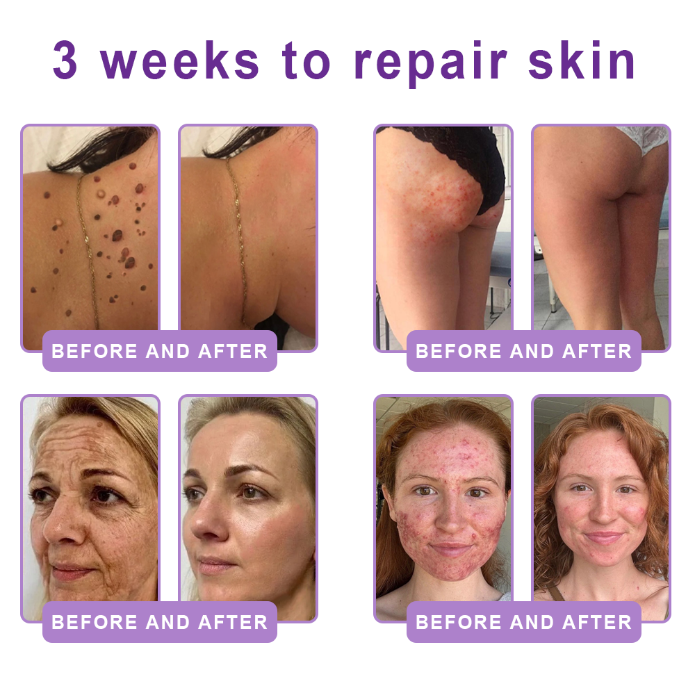 Limited-Time Offer⚡LIMETOW® PDRN Multi-Peptide Massaging Body Roller Cream- ✨𝐀𝐧𝐭𝐢-𝐚𝐠𝐢𝐧𝐠, Hydrating, Skin Firming & Lifting, Skin Repair, Even Tone, Acne and Dark Spot Treatment, Wart and Mole Removal, and Psoriasis Relief