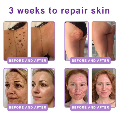 Limited-Time Offer⚡LIMETOW® PDRN Multi-Peptide Massaging Body Roller Cream- ✨𝐀𝐧𝐭𝐢-𝐚𝐠𝐢𝐧𝐠, Hydrating, Skin Firming & Lifting, Skin Repair, Even Tone, Acne and Dark Spot Treatment, Wart and Mole Removal, and Psoriasis Relief