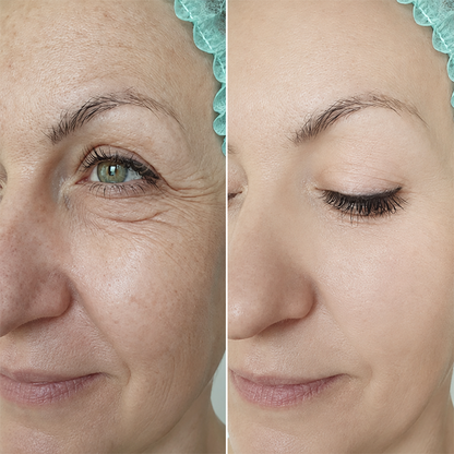 LIMETOW® Temporary Eye Tightener