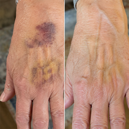 LIMETOW® Arnica Bruise Cream