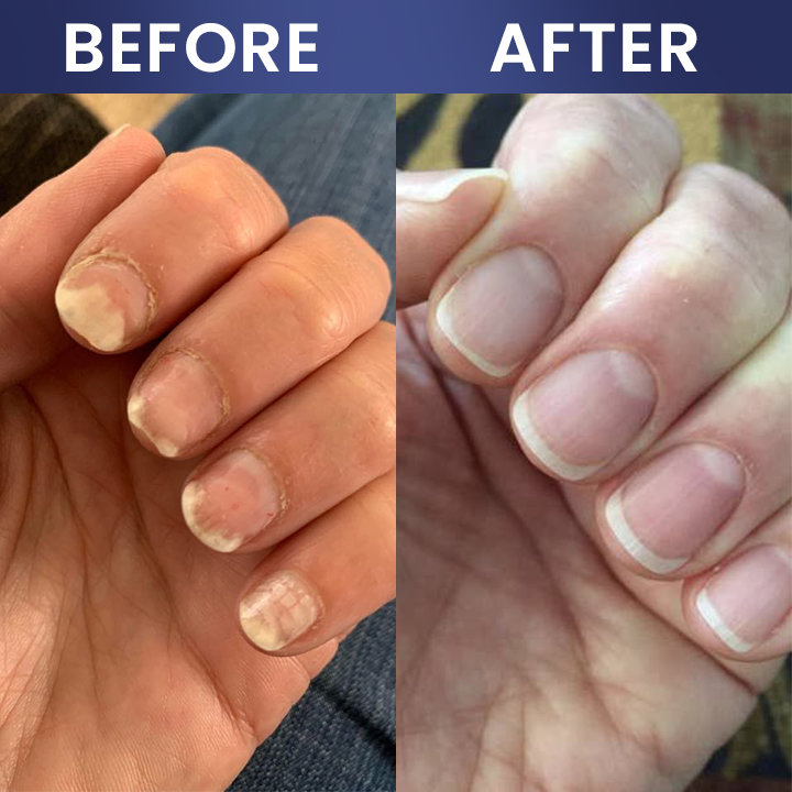 LIMETOW® Nail Repair Solution
