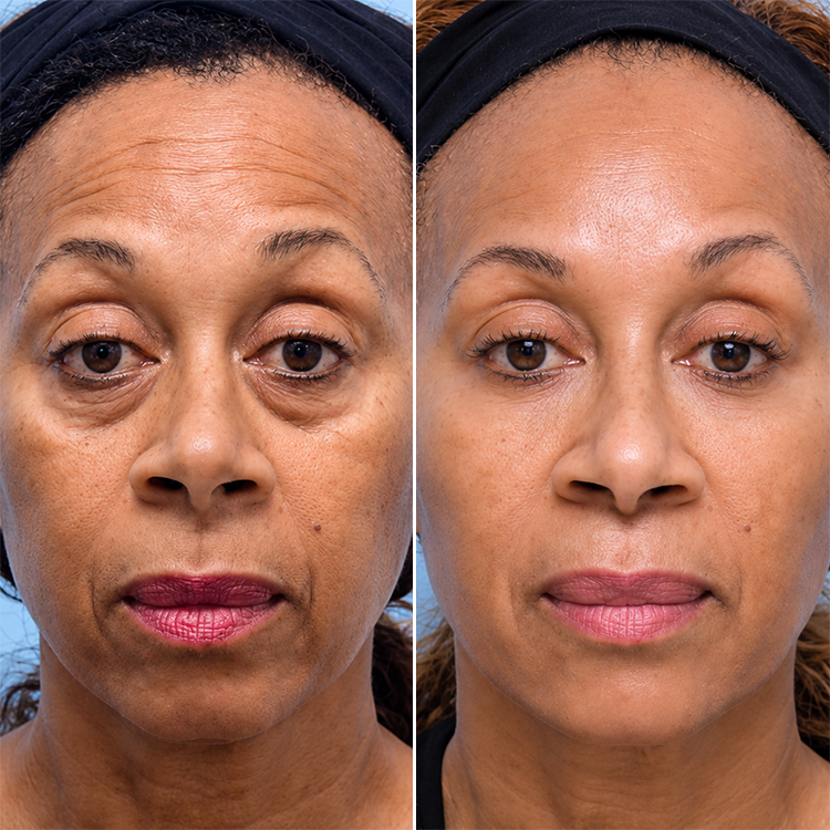 LIMETOW® Temporary Eye Tightener