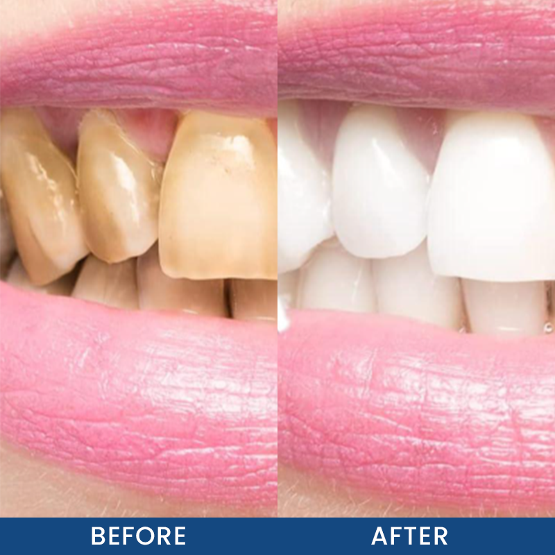 LIMETOW® Teeth Whitening Essence