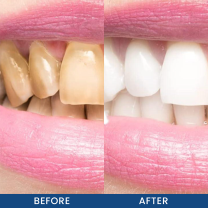 LIMETOW® Teeth Whitening Essence