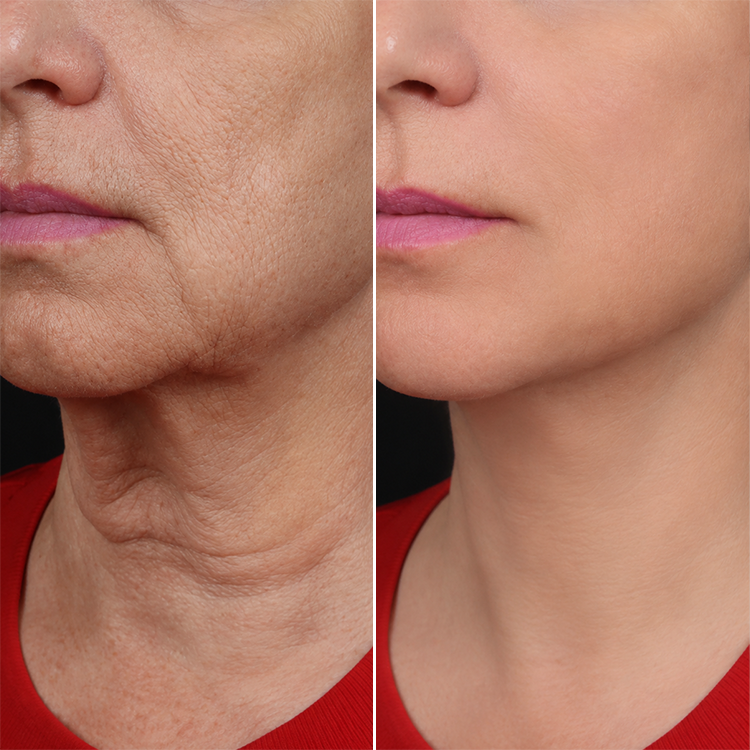 LIMETOW® Bee Venom Wrinkle Cream