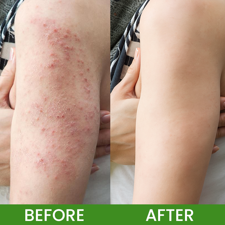 LIMETOW® Herbal Tinea Itching Cream image LIMETOW® Herbal Tinea Itching Cream