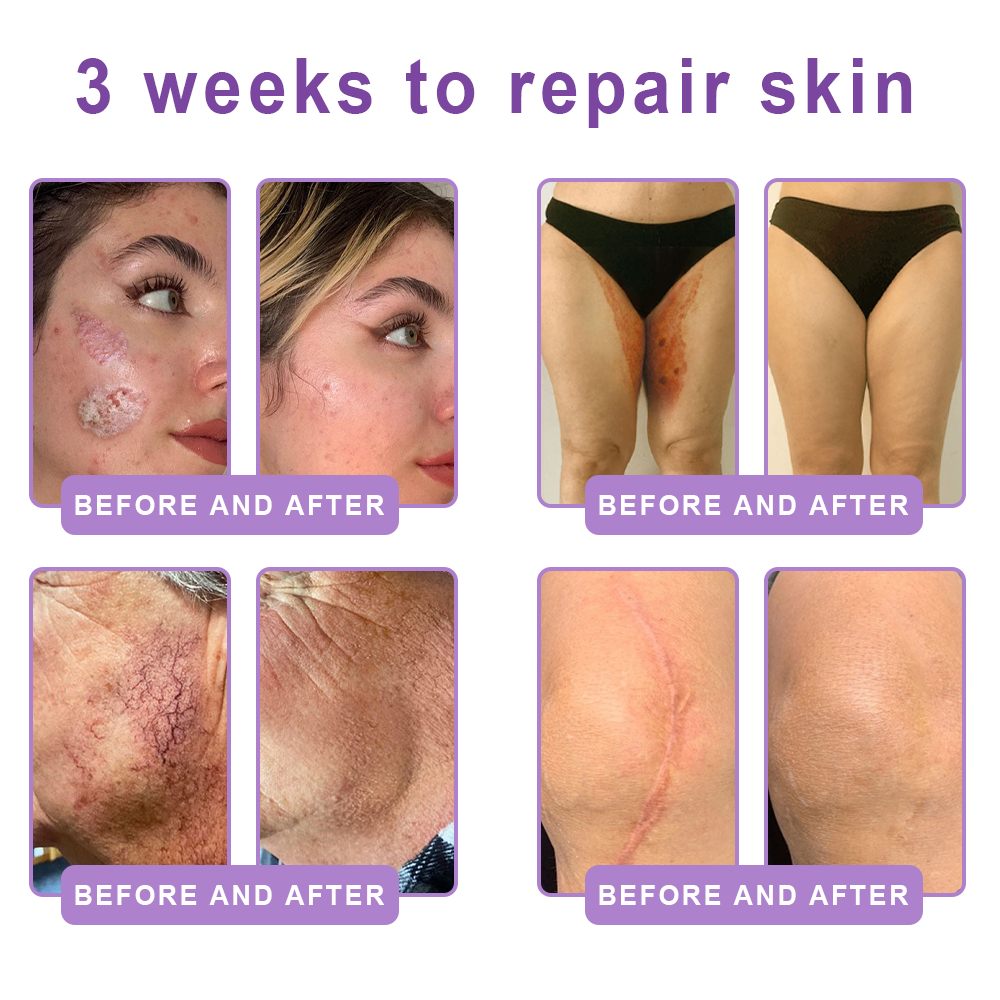 Limited-Time Offer⚡LIMETOW® PDRN Multi-Peptide Massaging Body Roller Cream- ✨𝐀𝐧𝐭𝐢-𝐚𝐠𝐢𝐧𝐠, Hydrating, Skin Firming & Lifting, Skin Repair, Even Tone, Acne and Dark Spot Treatment, Wart and Mole Removal, and Psoriasis Relief