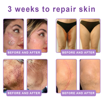 Limited-Time Offer⚡LIMETOW® PDRN Multi-Peptide Massaging Body Roller Cream- ✨𝐀𝐧𝐭𝐢-𝐚𝐠𝐢𝐧𝐠, Hydrating, Skin Firming & Lifting, Skin Repair, Even Tone, Acne and Dark Spot Treatment, Wart and Mole Removal, and Psoriasis Relief