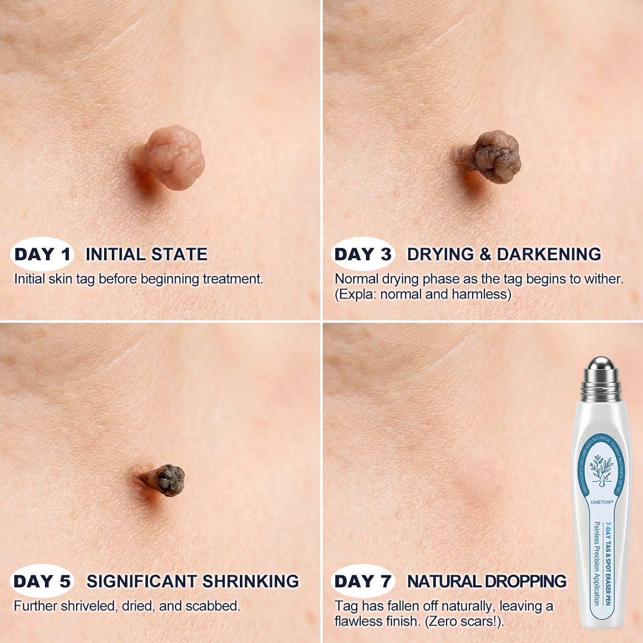 Limited-Time Offer⚡LIMETOW® ⚡Skin Tag & Spot Eraser | Remove skin tags / age spots / dark pigmentation / stubborn skin concerns / raised skin growths / small neck bumps…（副本）