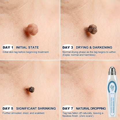 Limited-Time Offer⚡LIMETOW® ⚡Skin Tag & Spot Eraser | Remove skin tags / age spots / dark pigmentation / stubborn skin concerns / raised skin growths / small neck bumps…（副本）