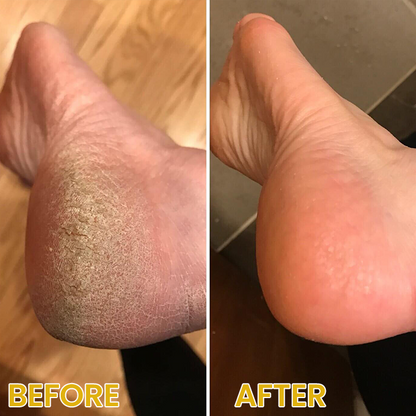 LIMETOW® Bee Venom Corn & Callus Remover Cream