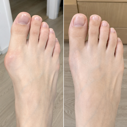 Bunion Corrector - Adjustable Bunion Splint