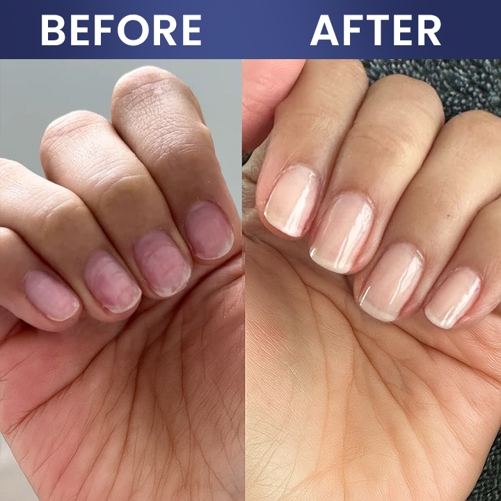 LIMETOW® Nail Repair Solution