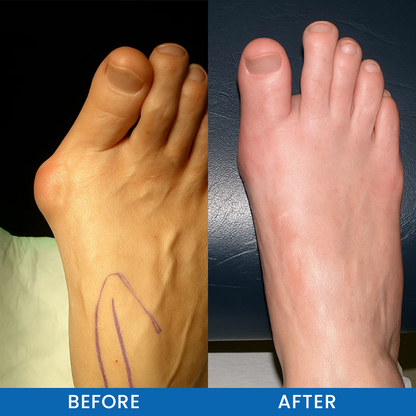 LIMETOW® Bunion-Free Solution