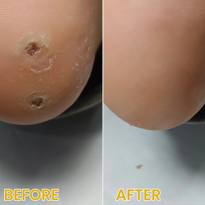 LIMETOW® Bee Venom Corn & Callus Remover Cream