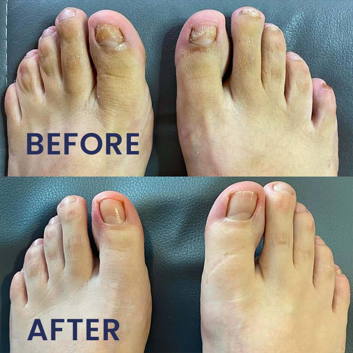 LIMETOW® Nail Repair Solution