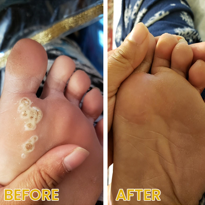 LIMETOW® Bee Venom Corn & Callus Remover Cream