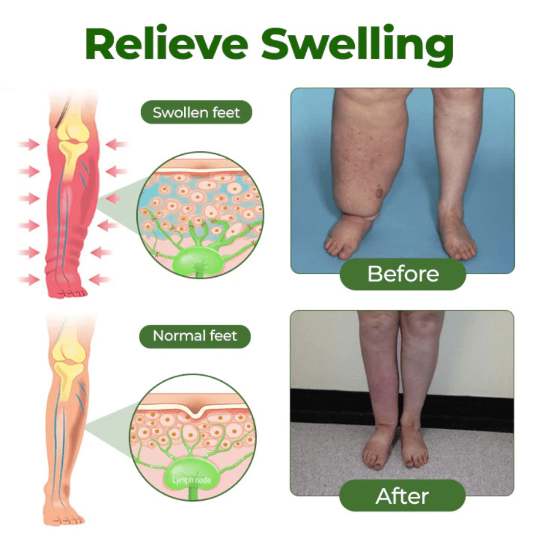 #1 Best Seller- 💥EDEMA RELIEF LOTION