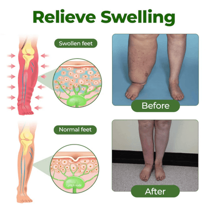 #1 Best Seller- 💥EDEMA RELIEF LOTION