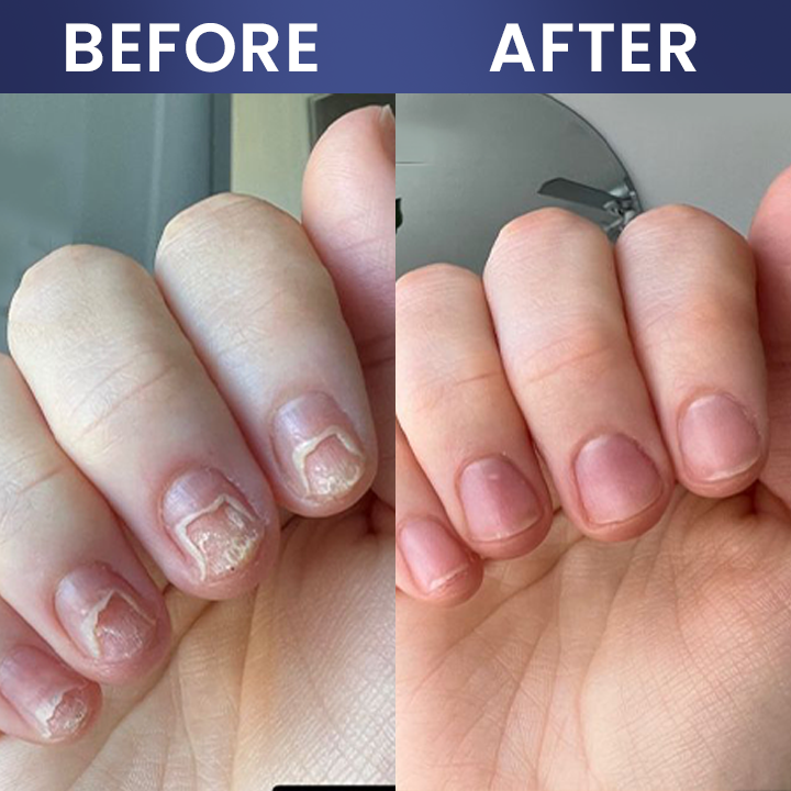 LIMETOW® Nail Repair Solution