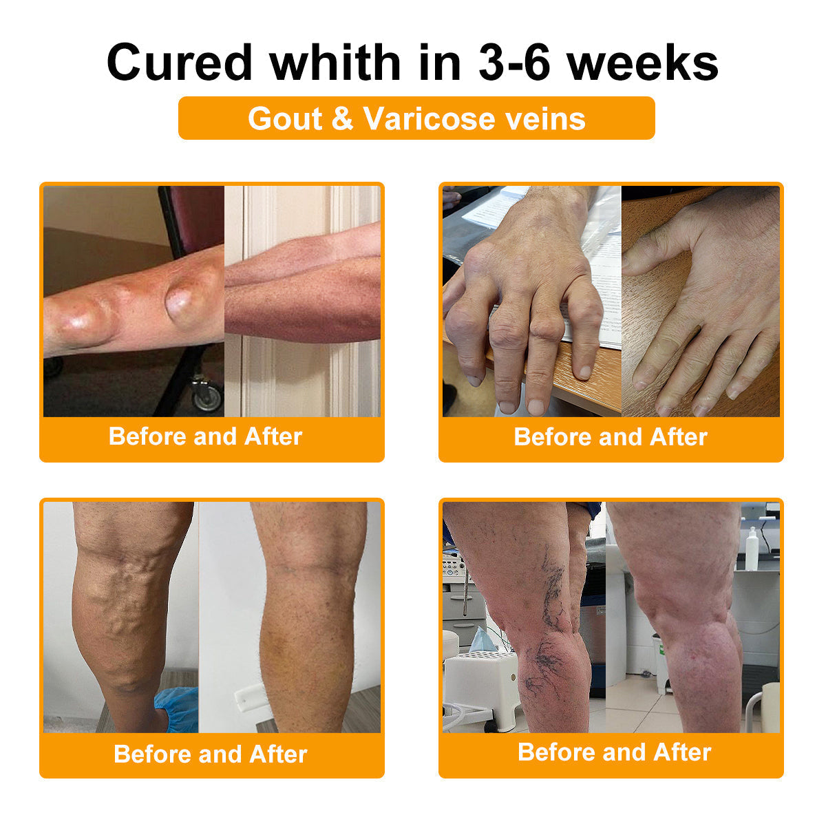 🎁Flash Sale - Botulinum Toxin & Bee Venom Pain-Relief Bone Healing Cream🐝💎