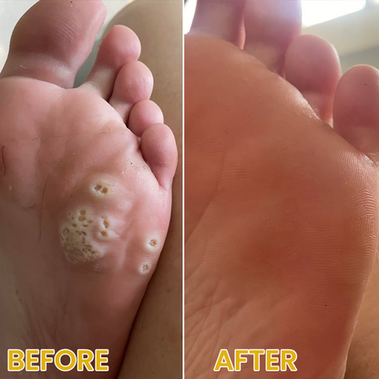 LIMETOW® Bee Venom Corn & Callus Remover Cream