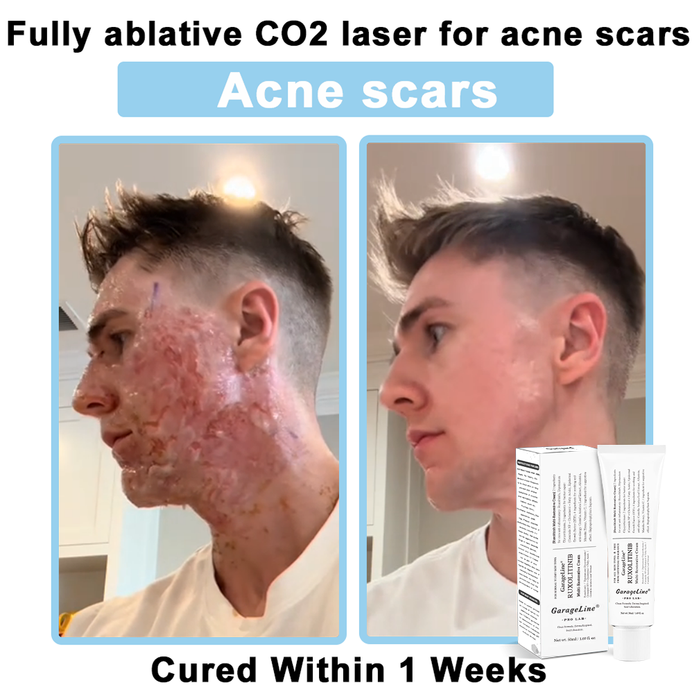 【Official US Store🔥】JAK-Smart Ruxolitinib Repair Complex 🌿（Zero Inflammation, 72H Sustained Release | Acne Clear in 10 Days | 97.7% Redness Reduction | Clinically Tested）