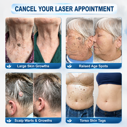 Skin Tag & Spot Eraser
