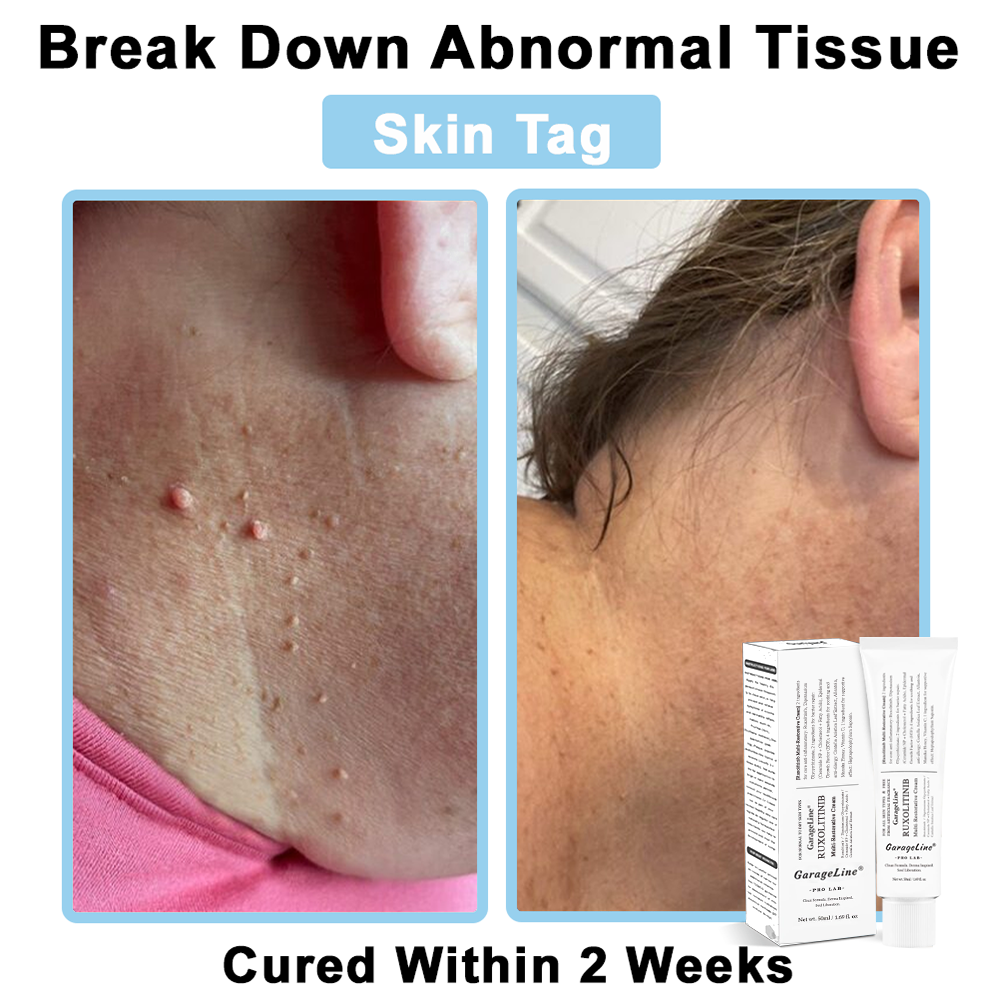 【Official US Store🔥】JAK-Smart Ruxolitinib Repair Complex 🌿（Zero Inflammation, 72H Sustained Release | Acne Clear in 10 Days | 97.7% Redness Reduction | Clinically Tested）
