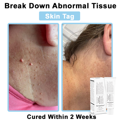 【Official US Store🔥】JAK-Smart Ruxolitinib Repair Complex 🌿（Zero Inflammation, 72H Sustained Release | Acne Clear in 10 Days | 97.7% Redness Reduction | Clinically Tested）