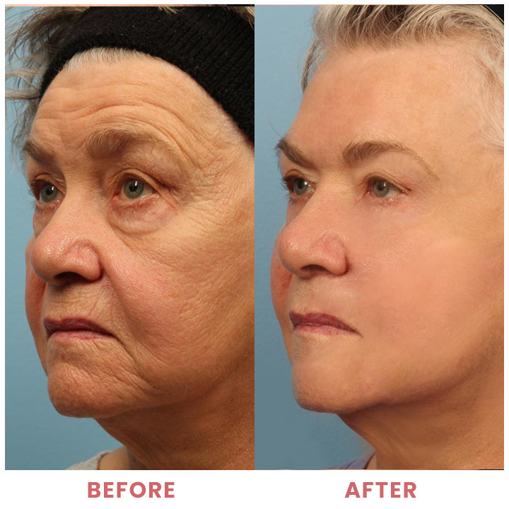 LIMETOW™ Compact Anti-wrinkle Bar image LIMETOW™ Compact Anti-wrinkle Bar