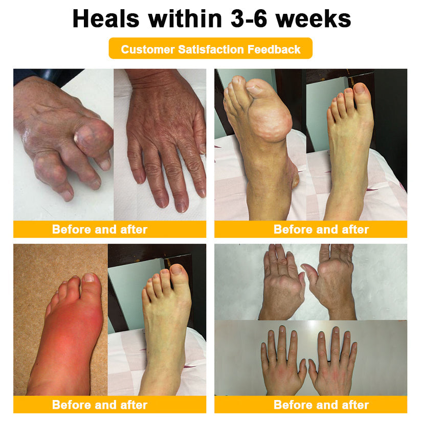 🎁Flash Sale - Botulinum Toxin & Bee Venom Pain-Relief Bone Healing Cream🐝💎
