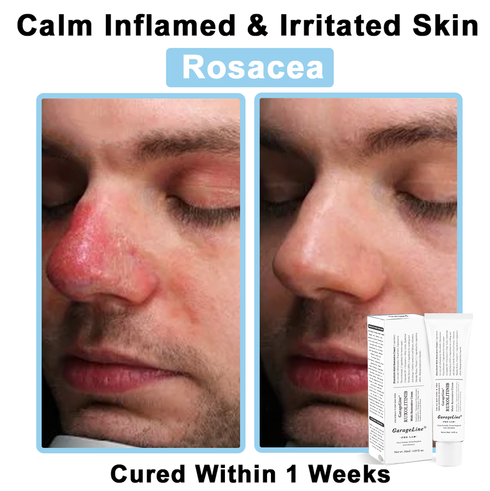 【Official US Store🔥】JAK-Smart Ruxolitinib Repair Complex 🌿（Zero Inflammation, 72H Sustained Release | Acne Clear in 10 Days | 97.7% Redness Reduction | Clinically Tested）