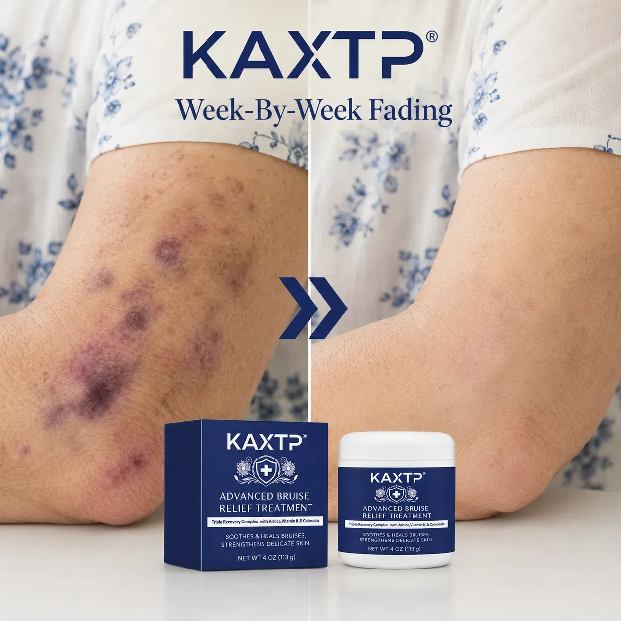 Those Purple Marks On Your Arms Aren't Your Fault, And KAXTP® Is Finally Something Gentle for Them