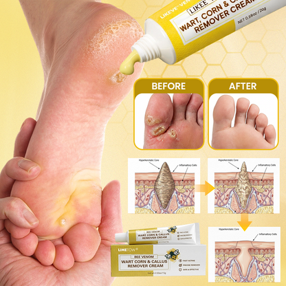 LIMETOW® Bee Venom Corn & Callus Remover Cream