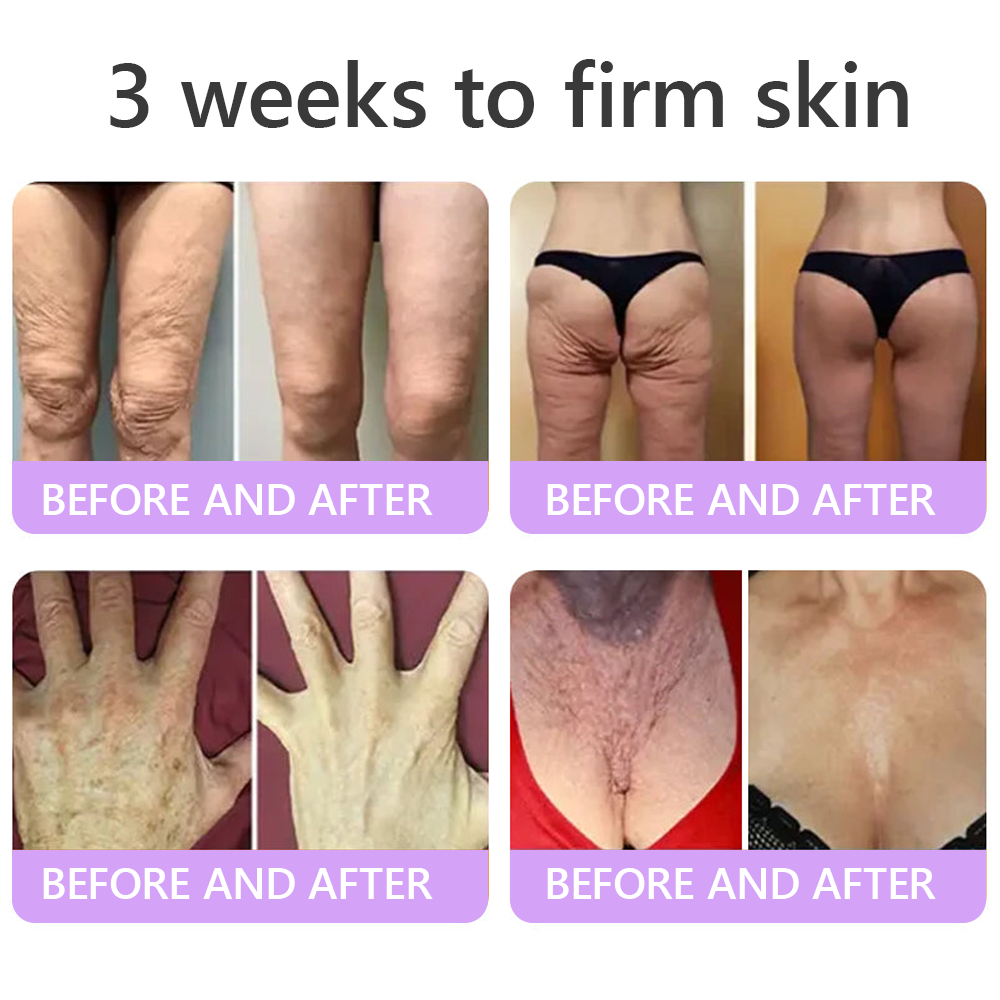 Limited-Time Offer⚡LIMETOW® PDRN Multi-Peptide Massaging Body Roller Cream- ✨𝐀𝐧𝐭𝐢-𝐚𝐠𝐢𝐧𝐠, Hydrating, Skin Firming & Lifting, Skin Repair, Even Tone, Acne and Dark Spot Treatment, Wart and Mole Removal, and Psoriasis Relief