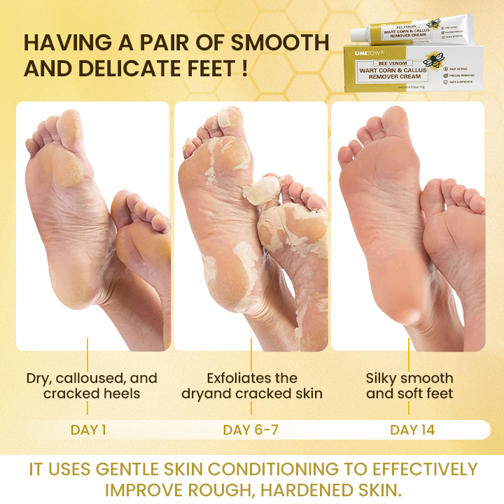LIMETOW® Bee Venom Corn & Callus Remover Cream
