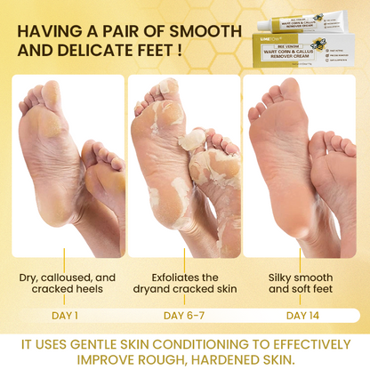 LIMETOW® Bee Venom Corn & Callus Remover Cream